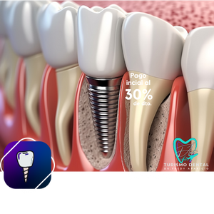 Un implante dental es una raíz artificial que se inserta dentro del hueso y se comporta de manera similar a la raíz natural. Luego de la osteointegración se coloca una corona dental en el sitio de reemplazo, devolviendo la estética y la función del diente natural. Estamos especializados en implantes dentales de carga inmediata.